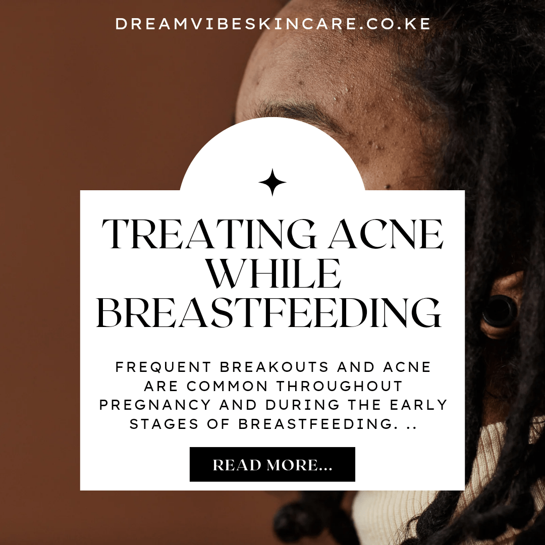 TreaTing acne while breastfeeding